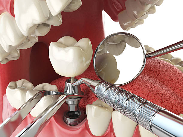 Best Emergency Tooth Extraction in Bruceville Eddy, TX